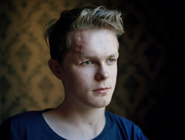 Viljar Hanssen var 17 år gammel, da han deltog i den politiske sommerlejr på Utøya i 2011 og blev ramt af skud i både hoved, skulder, hånd og lår. Han mistede synet på højre øje og måtte have tre fingre amputeret. I dag studerer han jura og er medlem af Tromsøs bystyre, men han lever også med frygten for, at projektilsplinterne, som stadig sidder i hans hjerne, en dag begynder at flytte på sig. En af dem ligger blot tre millimeter fra hovedpulsåren.
I 2012 blev han fotograferet til et fotoprojekt om terrorangrebets ofre. Arkivfoto: Andrea Gjestvang, Panos Pictures.
